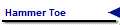 Hammer Toe