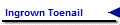 Ingrown Toenail