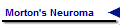 Morton's Neuroma