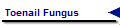 Toenail Fungus