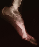 xfoot